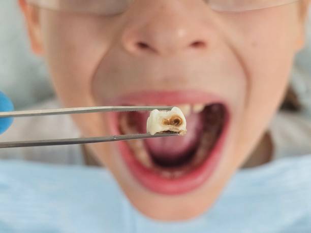 Best Emergency Gum Treatment in Manvel, TX